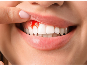  Nguyên nhân chảy máu chân răng là do đâu?